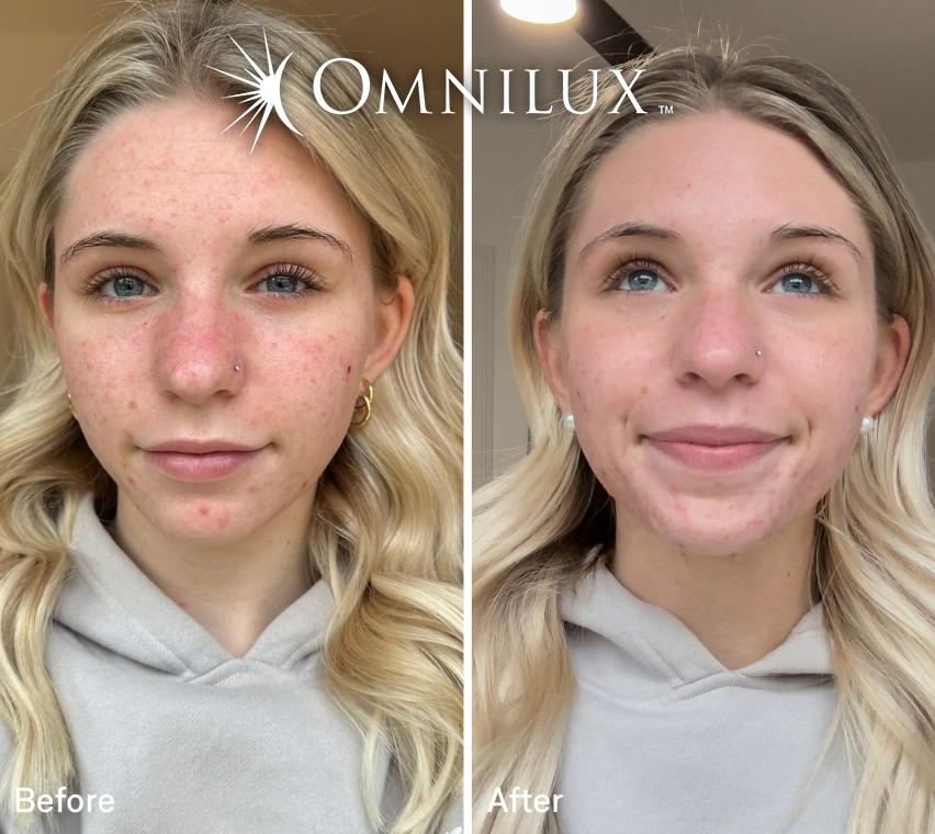 Omnilux Clear Blue+Red LED Light Therapy Mask